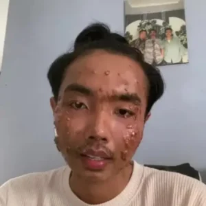 Bahaya Pakai Baju Bekas! TikToker Idap Penyakit Kulit Mengerikan