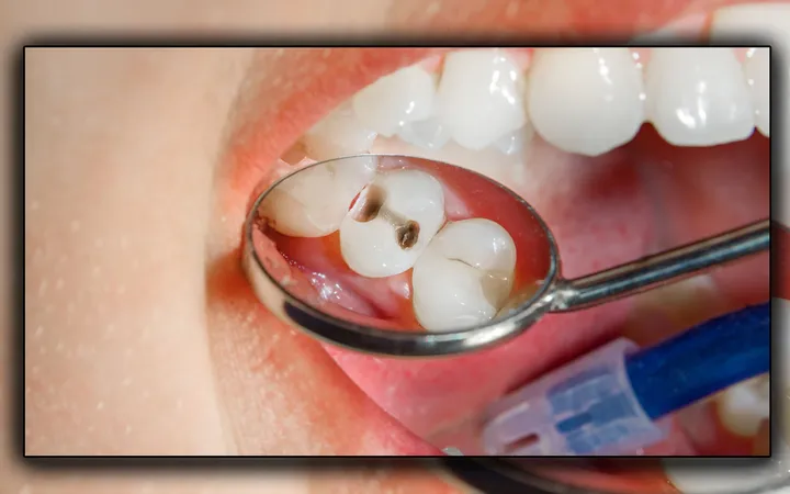 Rahasia Ampuh Atasi Gigi Berlubang Permanen Tanpa Fluoride