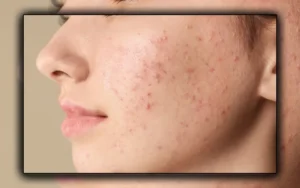 Rahasia Ampuh Hilangkan Jerawat Secara Alami dan Cepat